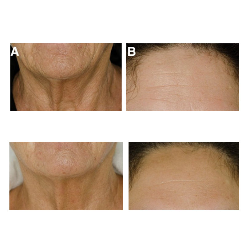 LED Light Therapy Before and After Results for Anti-Aging